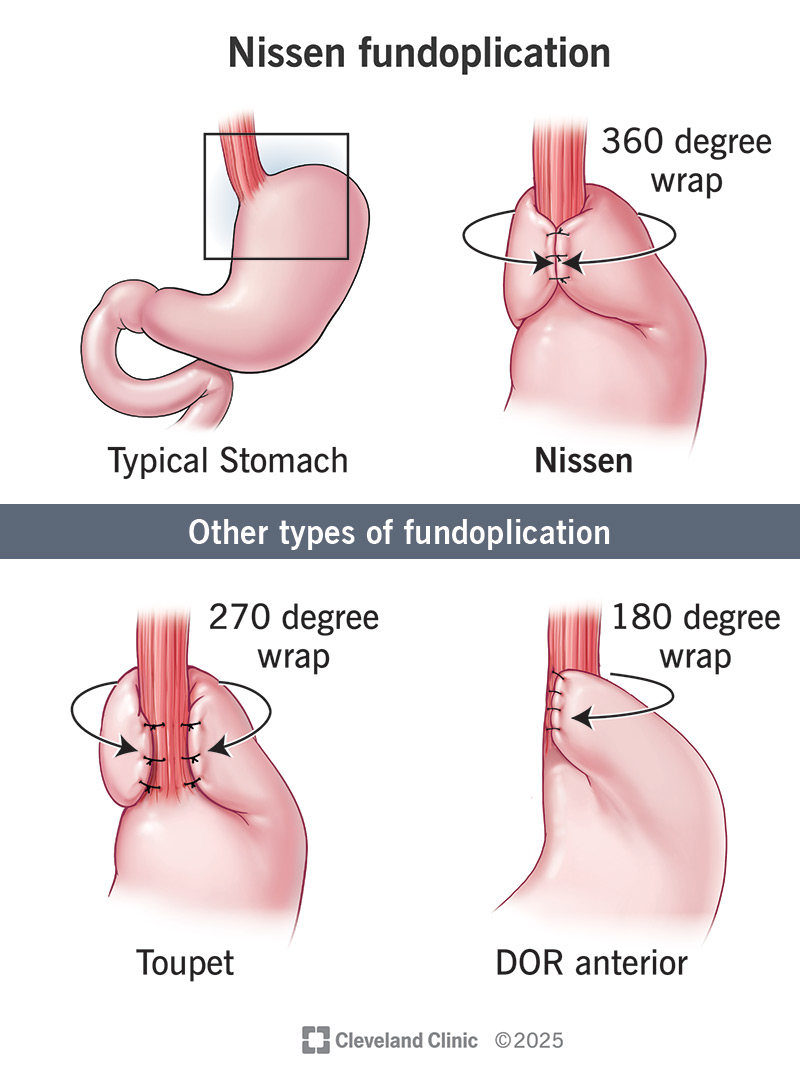 Illustration of Nissen Fundoplication surgery